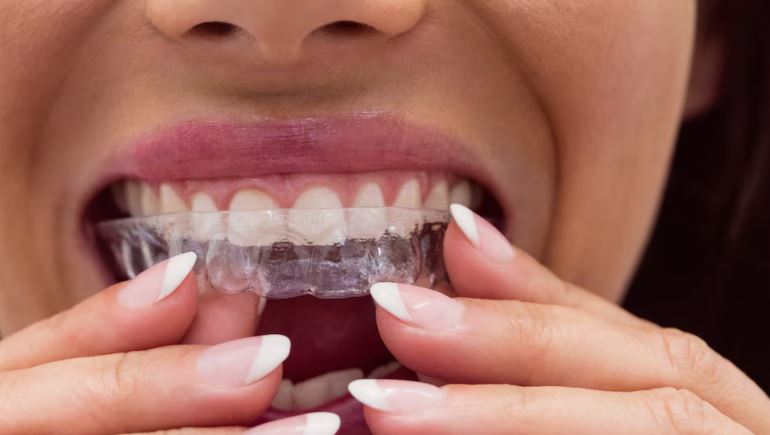 Invisible Aligners